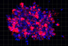 Pancreatic cancer