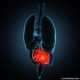 Diverticulitis